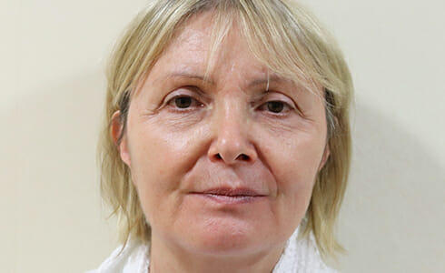 Rhinoplasty Client 8 Before Surgery