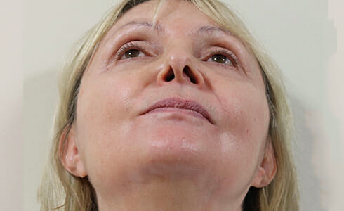 Rhinoplasty Client 7 Before Surgery