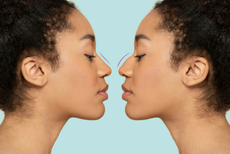Types of Nose Surgery