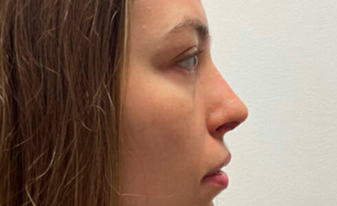 Rhinoplasty Client After Surgery