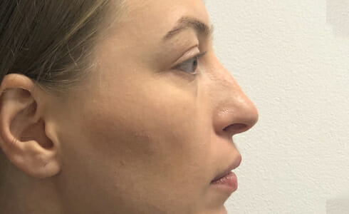 Rhinoplasty Client Before Surgery