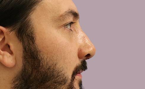 Rhinoplasty Client 3 Before Surgery Side Profile