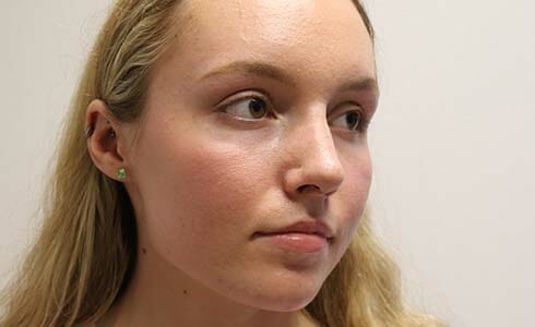 Rhinoplasty Client 3 Before Surgery