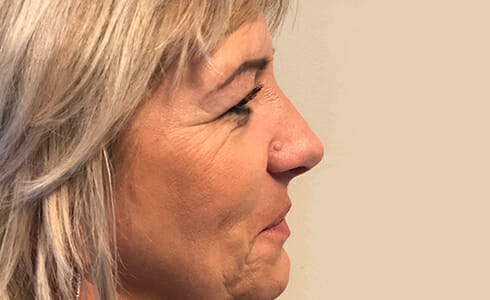 Rhinoplasty Client 6 After Surgery Side Profile