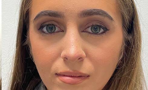Rhinoplasty Client After Surgery