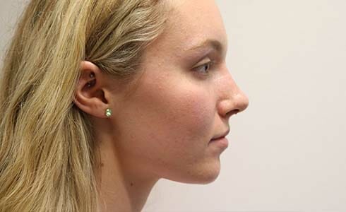 Rhinoplasty Client 3 Before Surgery Side Profile