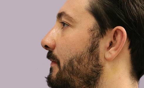 Rhinoplasty Client 5 After Surgery Side Profile