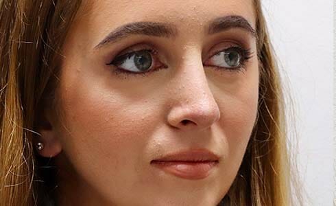 Rhinoplasty Client After Surgery