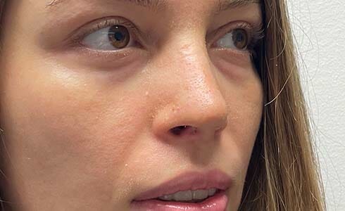 Rhinoplasty Client After Surgery