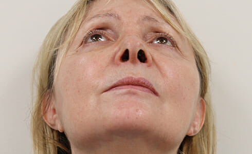 Rhinoplasty Client 7 After Surgery