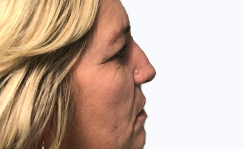 Rhinoplasty Client 6 Before Surgery Side Profile