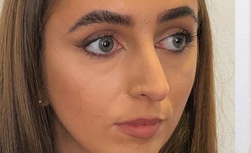 Rhinoplasty Client After Surgery