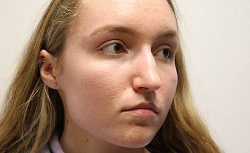 Rhinoplasty Client 3 Before Surgery