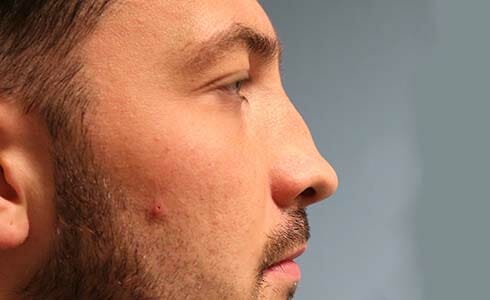 Rhinoplasty Client 4 Before Surgery Side Profile