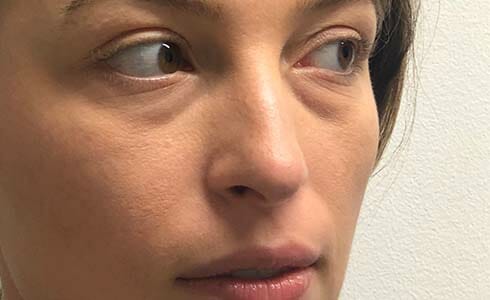 Rhinoplasty Client Before Surgery