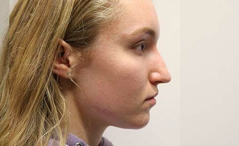 Rhinoplasty Client 3 Before Surgery Side Profile