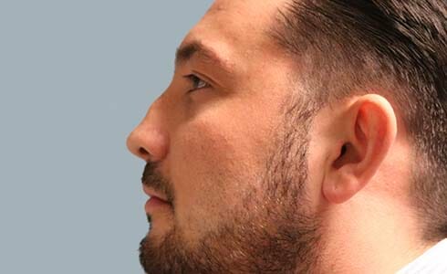 Rhinoplasty Client 5 Before Surgery Side Profile