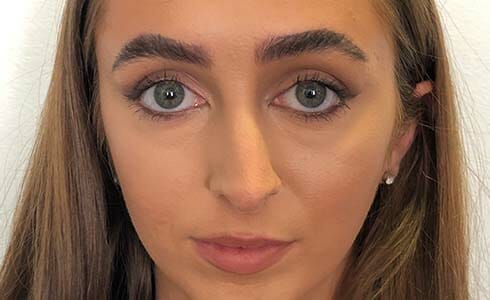 Rhinoplasty Client After Surgery