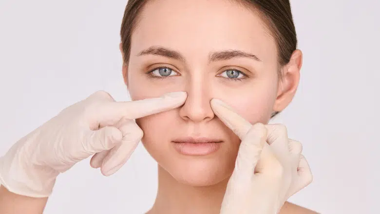 Bulbous Nasal Tip