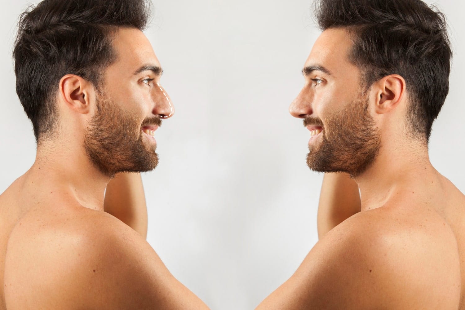 male Rhinoplasty in the London